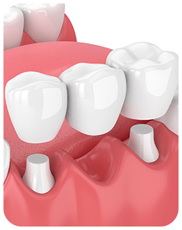 Dental Bridges | Canterra Dental Centre | Downtown Calgary | General and Family Dentist