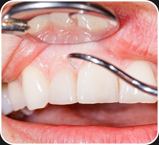 Dental Hygiene | Periodontal Dentistry | Canterra Dental Centre | Downtown Calgary | General and Family Dentist