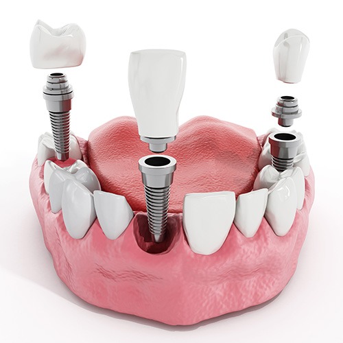 Dental Implants