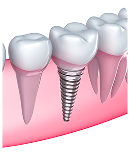 Dental Implants | Canterra Dental Centre | Downtown Calgary | General and Family Dentist