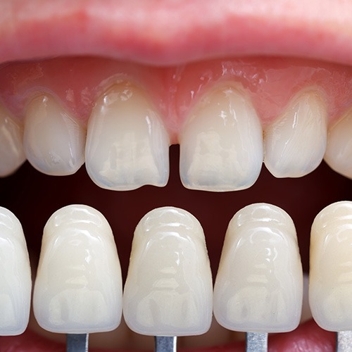 Dental Veneers