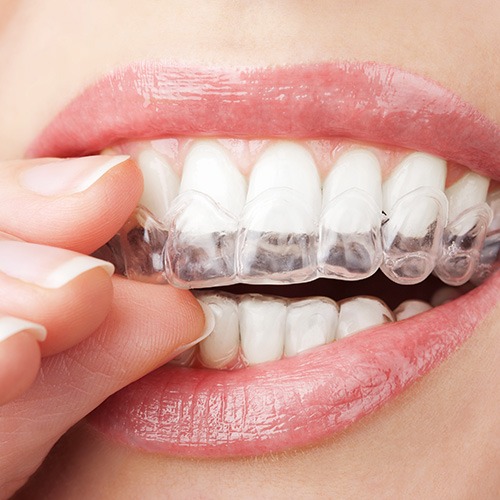 Invisalign