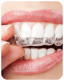 Invisalign Clear Aligners | Canterra Dental Centre | Downtown Calgary | General and Family Dentist