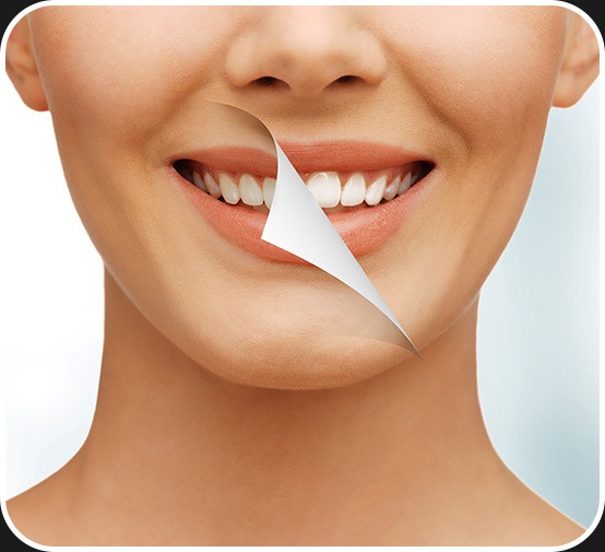 Teeth Whitening | Canterra Dental Centre | Downtown Calgary | General and Family Dentist