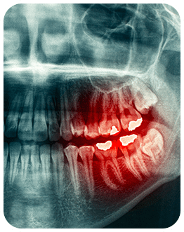 Wisdom Teeth Extraction | Canterra Dental Centre | Downtown Calgary | General and Family Dentist