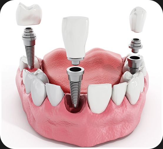 Dental Implants | Canterra Dental Centre | Downtown Calgary | General and Family Dentist