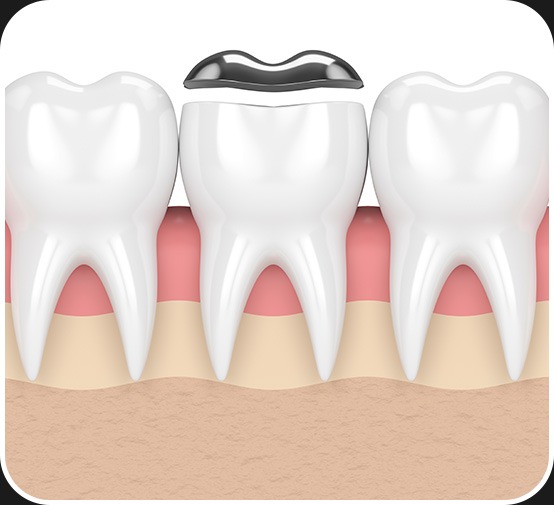 Restorative Dentistry | Dental Onlay | Canterra Dental Centre | Downtown Calgary | General and Family Dentist